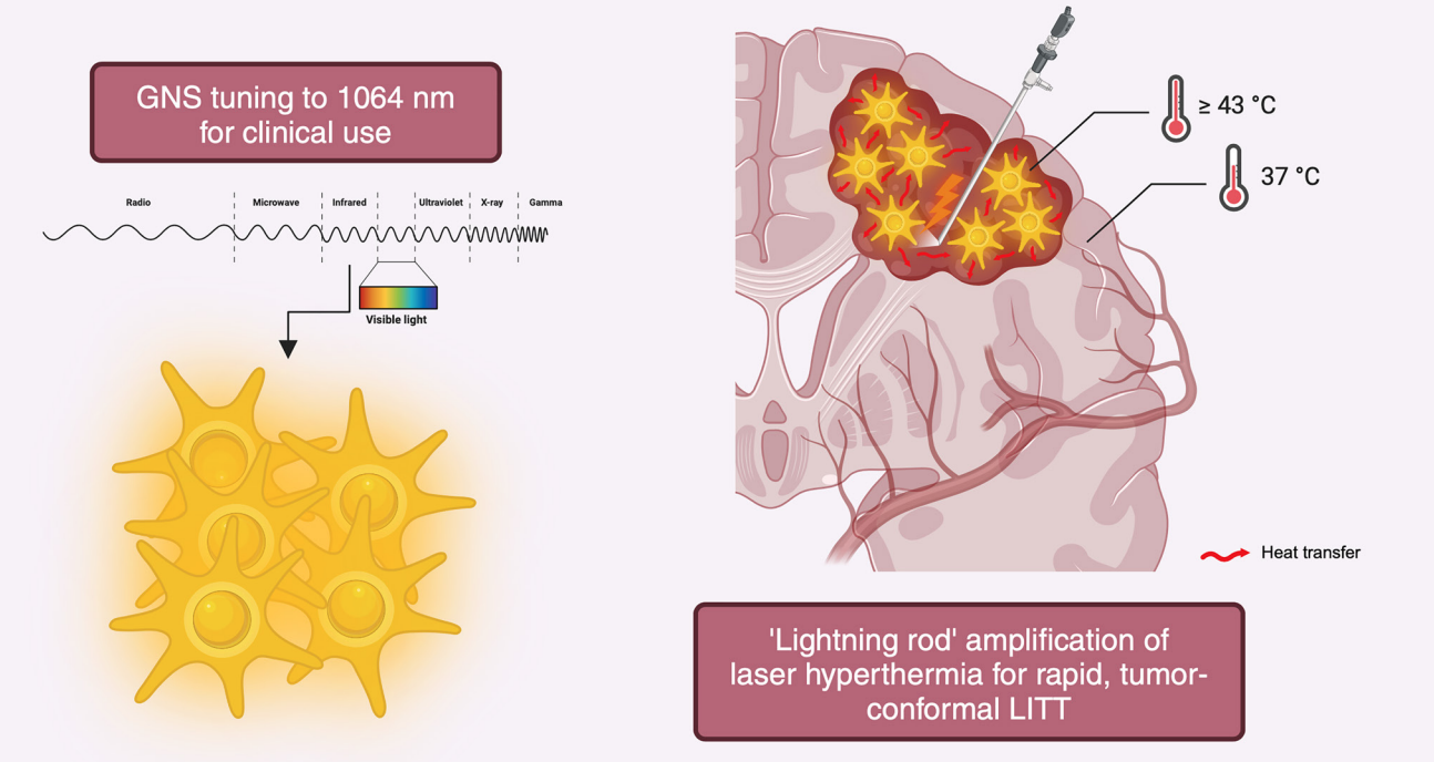 Leveraging Gold Nanostars for Precision Laser Interstitial Thermal Therapy