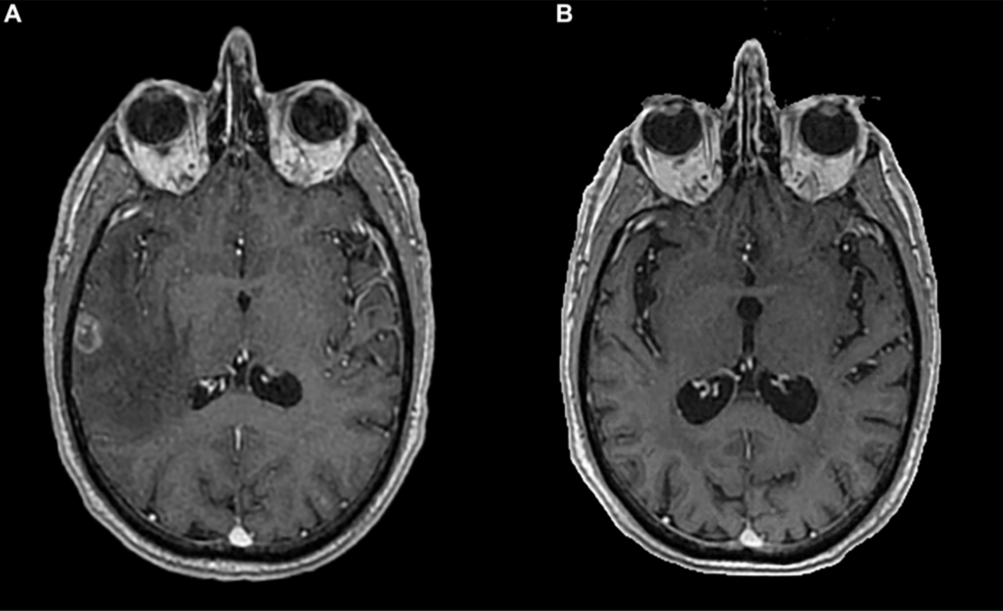 Long-lasting Immunotherapy Response in Stage IV Lung Cancer with Brain Metastasis