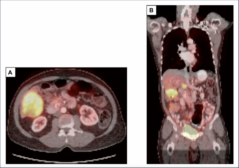 Immunotherapy Success in KRAS G12C Adenosquamous Pancreatic Cancer