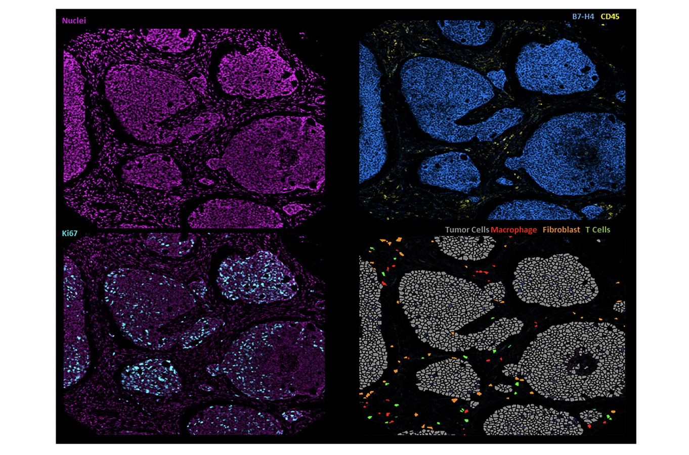 B7-H4 as a Therapeutic Target in Adenoid Cystic Carcinoma