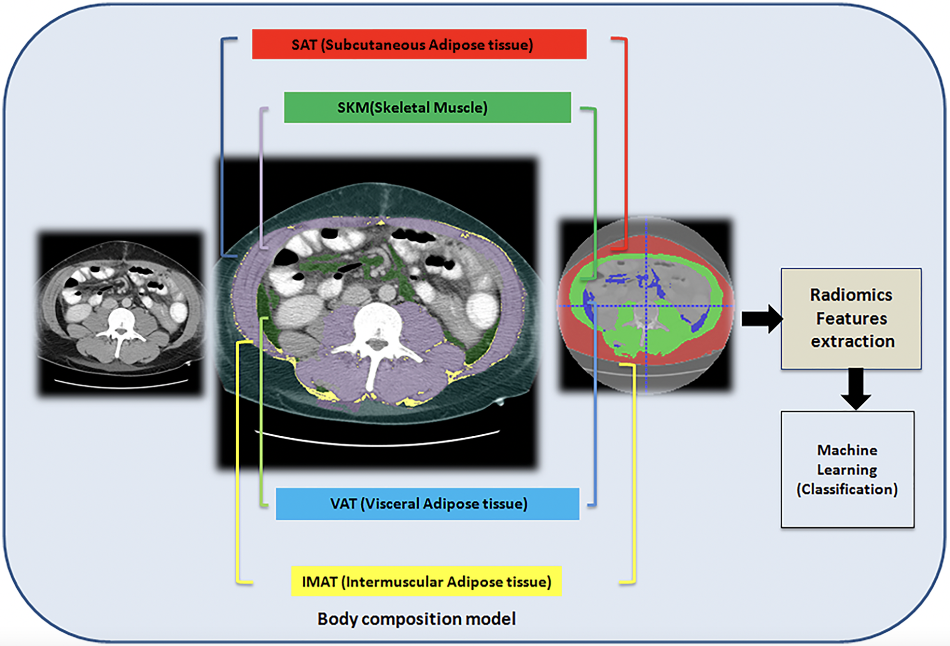 CT Radiomics and Body Composition for Predicting Hepatic Decompensation