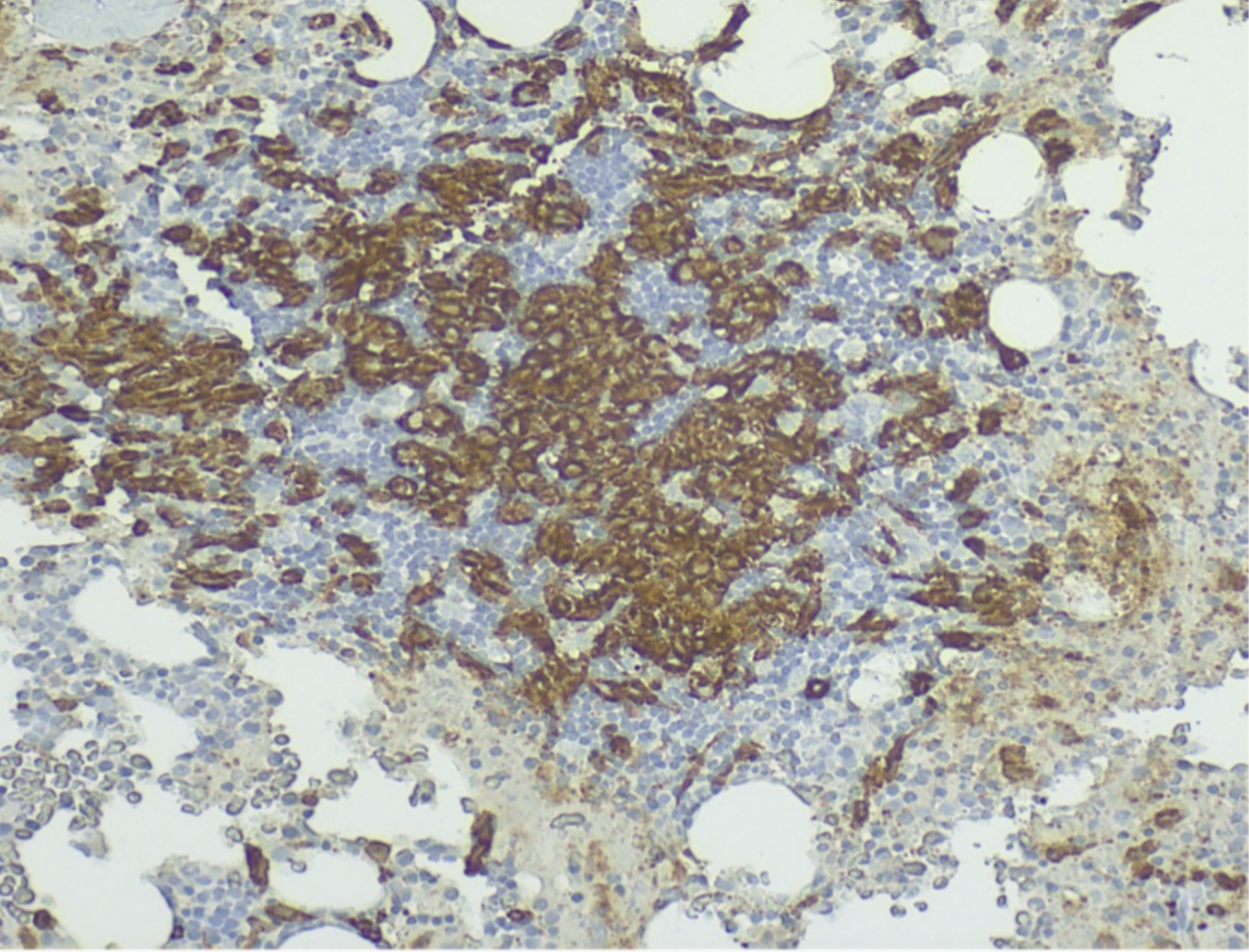 Severe Osteoporosis as a Manifestation of Systemic Mastocytosis