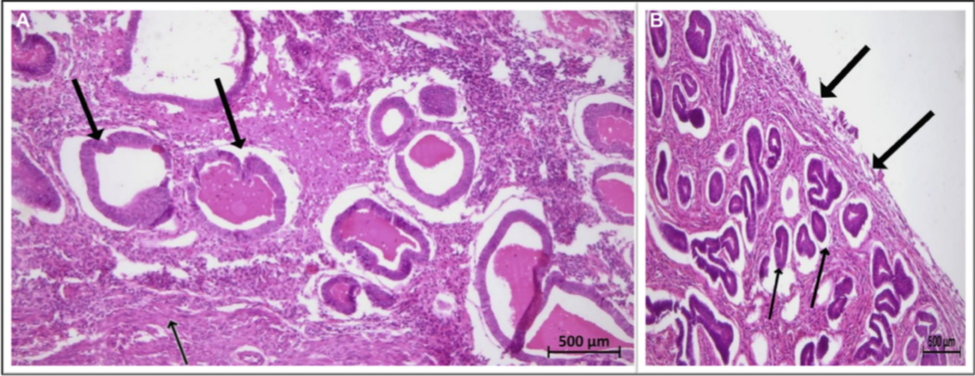 Rare Uterine Condition Mimics Cancer in Postmenopausal Woman